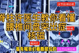 神经脊柱许医生教你看懂腰椎间盘突出症核磁视频封面