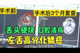 舌头长肿块，口腔长溃疡，确诊恶性舌癌！手术3个月复查恢复良好视频封面
