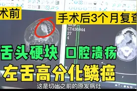 舌头长肿块，口腔长溃疡，确诊恶性舌癌！手术3个月复查恢复良好视频封面