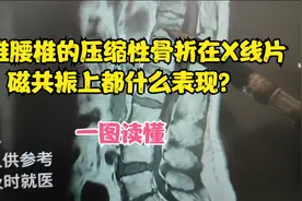 胸椎腰椎压缩性骨折在X线片、磁共振上都是什么表现？一图详解视频封面