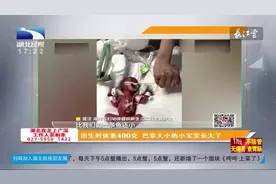 出生时体重400克，巴掌大小的小宝宝长大了，创下医学奇迹