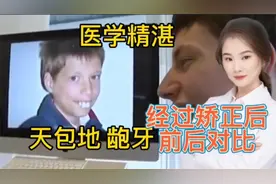 天包地 大龅牙经过矫正后，前后对比 大赞医术精湛