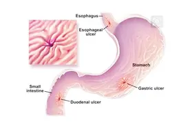腹胀还呕血，可能是这三个原因造成，最好去医院看一下视频封面