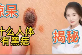 医学揭秘 人为什么会有这么多黑痣 如何产生黑色素 探索人体秘密视频封面
