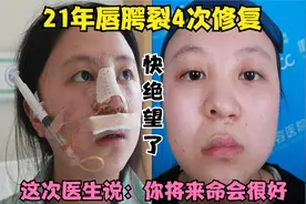 21年唇腭裂修复4次，医生说：你将来的命会很好！妹子鼻整形记录视频封面