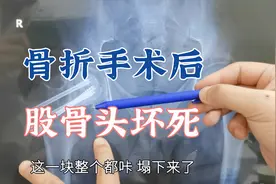 外伤导致骨折，手术做得很好，为什么却出现继发性的股骨头坏死？视频封面