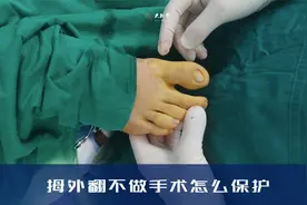 大脚骨平时怎么保护？如果不做手术，拇外翻有哪些保护措施视频封面