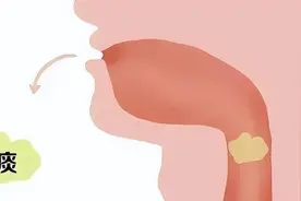 感冒后咳嗽有黄痰是快好了，还是病情加重？