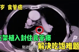 食管癌患者食管瘘怎么办？支架植入完美贴合瘘口，解决吃饭难题视频封面