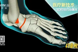 医疗新技术！3D打印距骨，巧治踝关节坏死，快来看一看|生活圈视频封面
