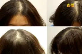 B族维生素能缓解脱发？医生解答：对这一类脱发有效！视频封面