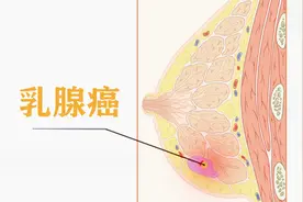 乳房胀痛、有肿块会是乳腺癌前兆吗？#滚蛋吧肿瘤君# #清风计划#视频封面