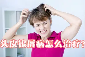 头上总是有白屑，头皮银屑病怎么治疗？医生给出1药，效果好视频封面