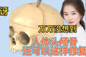 医学演绎 人体的头颅骨开裂 如何进行缝合修整 开颅缝合整骨