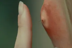 女孩脸上鼓个大包，还长出一根黑毛，用手轻轻一碰居然会动！视频封面