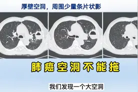 肺癌出现空洞，提示进展较快，要争取及时治疗视频封面