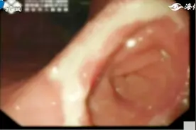 三岁男娃极度贫血，长期挑食爱吃烤肠，胃里形成巨大胃石视频封面