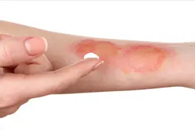 烫伤后黑印多久能消退？药师教你如何选药，是愈合关键