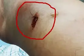 男子被剧毒蛇咬了一口，生死关头教科书式操作自救成功视频封面