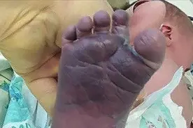助产士接生太粗暴,把新生儿双腿扯骨折!网友孩子双脚变蓝色了视频封面