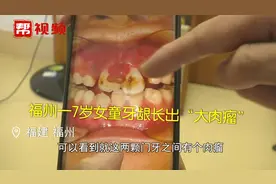 诊所看牙后女童牙龈竟长出“大肉瘤”，医生：牙龈内藏皮筋是元凶