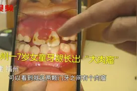 诊所看牙后女童牙龈竟长出“大肉瘤”，医生：牙龈内藏皮筋是元凶