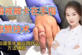 小黑哥手指被婚戒卡住，看外科医生是如何摘取的， 医术精湛视频封面