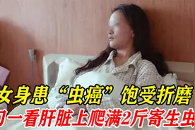 花季少女身患虫癌，医生开刀后吓了一跳，肝脏上爬满2斤寄生虫！视频封面