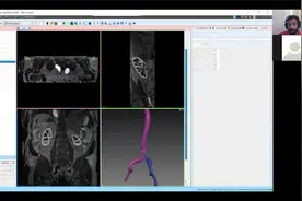 SimVascular Tutorial 5 Model Building
