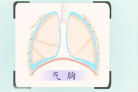 什么是新生儿气胸？有哪些症状？视频封面