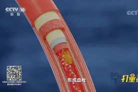 血管越细，血流速度越慢，就越容易堵，从而形成血栓|创新进行时视频封面