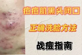 脸上长痘痘时怎么正确洗脸？痘痘肌的正确洗脸方式！痘痘无处可逃