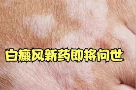 白癜风新药即将上市，这是一种什么药呢？赶紧先来了解一下视频封面