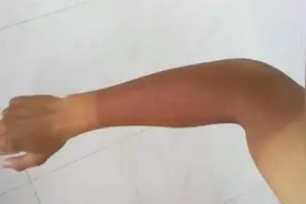 夏天皮肤晒黑别着急，教你一招，几毛钱成本，白皙皮肤自然白回来