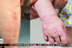 大伯每天热水泡澡，皮肤却瘙痒难忍，医生一语道破视频封面