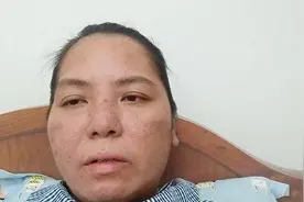 患尿毒症晚期，靠机器维持生命，脸色一天比一天差，身体无比难受视频封面