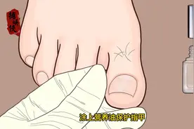 帅哥的脚长了甲沟炎，看医生如何修剪，全程超级解压下饭.