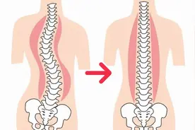 脊柱侧弯的自我康复训练，每天4个动作，腰直了背也挺了