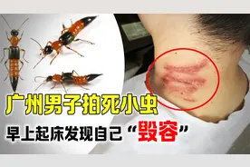 广州男子拍打隐翼虫，第2天发现身上长泡，为什么会这样？视频封面