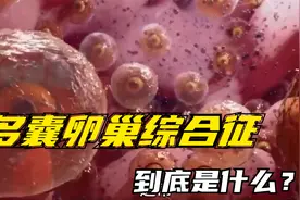 什么是多囊卵巢综合征？看完这段就明白，涨知识了视频封面