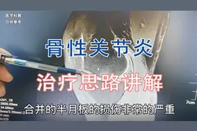 不同程度的骨性关节炎治疗方式不同，肖教授分析病情讲解治疗思路视频封面