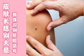 会不会癌变？如何判断自己的痣需要切除，专家来教你视频封面