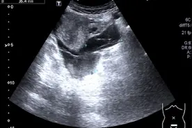 23岁女子赖床憋尿导致黄体破裂，盆腔积血达500毫升视频封面