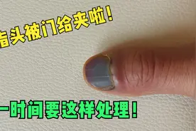 手指受外力挤压变黑怎么办？别急，第一时间正确的处理方法在这里视频封面