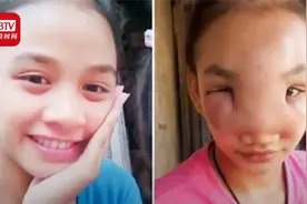 再也不敢挤痘痘了菲律宾17岁女孩挤鼻子上的痘致全脸肿胀近乎失明视频封面