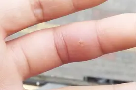 手上扎了木刺不要用针挑，学会这两招，木刺自己跑出来！视频封面