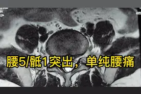 腰椎间盘突出导致的单纯腰痛很少需要术治疗，除非是顽固性腰痛视频封面