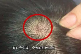 为何头皮总长脓包和疙瘩？提醒：或与4点原因有关视频封面