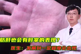 脂肪肝也会出现肝掌？医生：发展到一定程度会出现，要引起注意视频封面