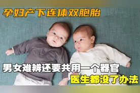 孕妇产下连体双胞胎，男女难辨还要共用一个器官，医生都没了办法
